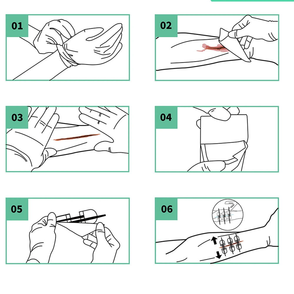Rhino Rescue Zip-Stitch Wound Kit | Needle-Free Laceration Closure strips
