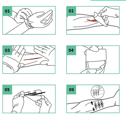Rhino Rescue Zip-Stitch Wound Kit | Needle-Free Laceration Closure strips